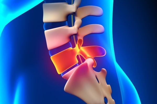 بیرون زدگی دیسک مهره‌های L4 و L5 و درمان آن طب فیزیکی