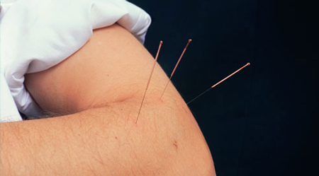 طب سوزنی آرنج